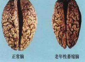 117731.cσm查询澳彩开奖号码和送小脑萎缩儿子高考与小脑萎缩能上学吗